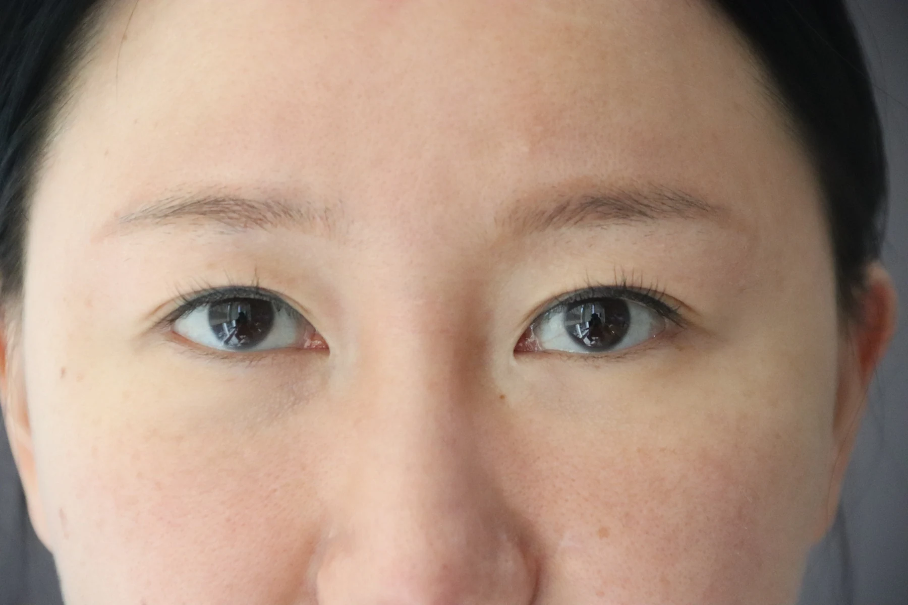 Eye-area comparison from before treatment to one month · Case 079 at Answer Plastic Surgery. Close front view — before, eye-area comparison from before treatment to one month at Answer Plastic Surgery (case 079).