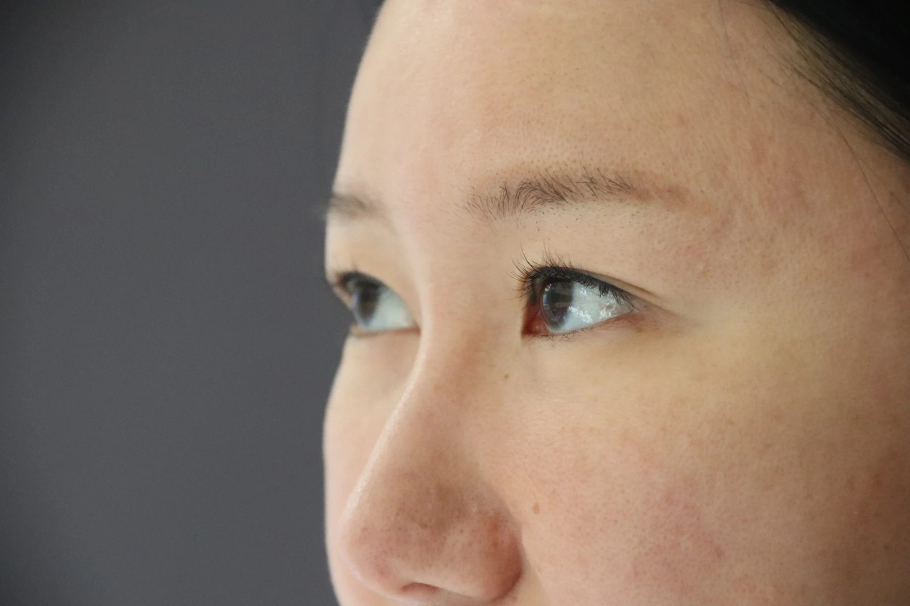 Eye-area comparison from before treatment to one month · Case 079 at Answer Plastic Surgery. Angled view — before, eye-area comparison from before treatment to one month at Answer Plastic Surgery (case 079).