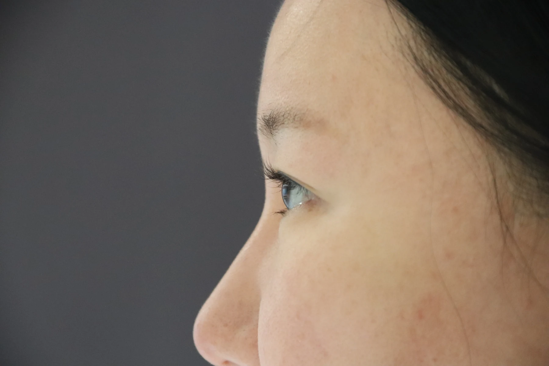 Eye-area comparison from before treatment to one month · Case 079 at Answer Plastic Surgery. Side view — before, eye-area comparison from before treatment to one month at Answer Plastic Surgery (case 079).