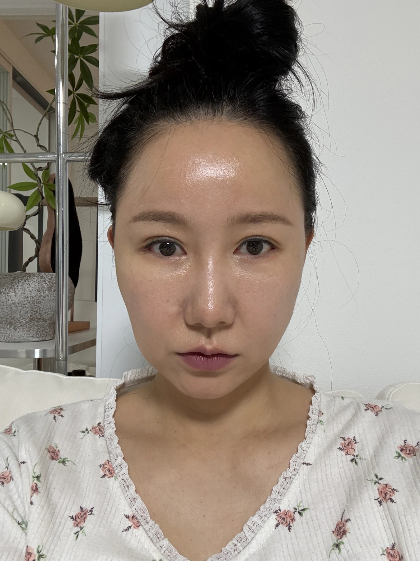 Eye-area comparison from before treatment to one month · Case 079 at Answer Plastic Surgery. Front view — 1 week, eye-area comparison from before treatment to one month at Answer Plastic Surgery (case 079).