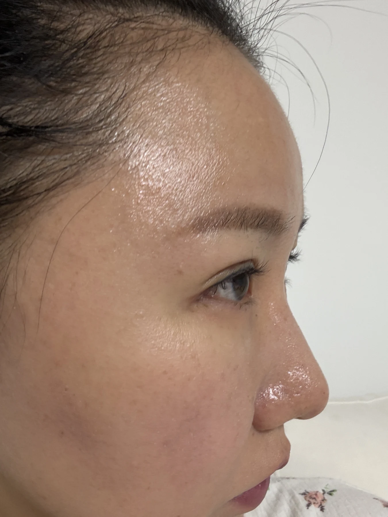 Eye-area comparison from before treatment to one month · Case 079 at Answer Plastic Surgery. Angled view — 1 week, eye-area comparison from before treatment to one month at Answer Plastic Surgery (case 079).