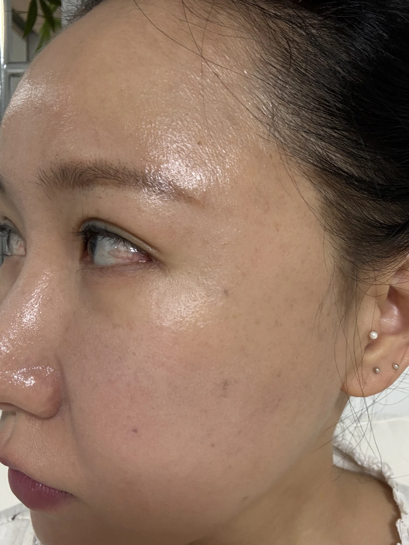 Eye-area comparison from before treatment to one month · Case 079 at Answer Plastic Surgery. Opposite angled view — 1 week, eye-area comparison from before treatment to one month at Answer Plastic Surgery (case 079).