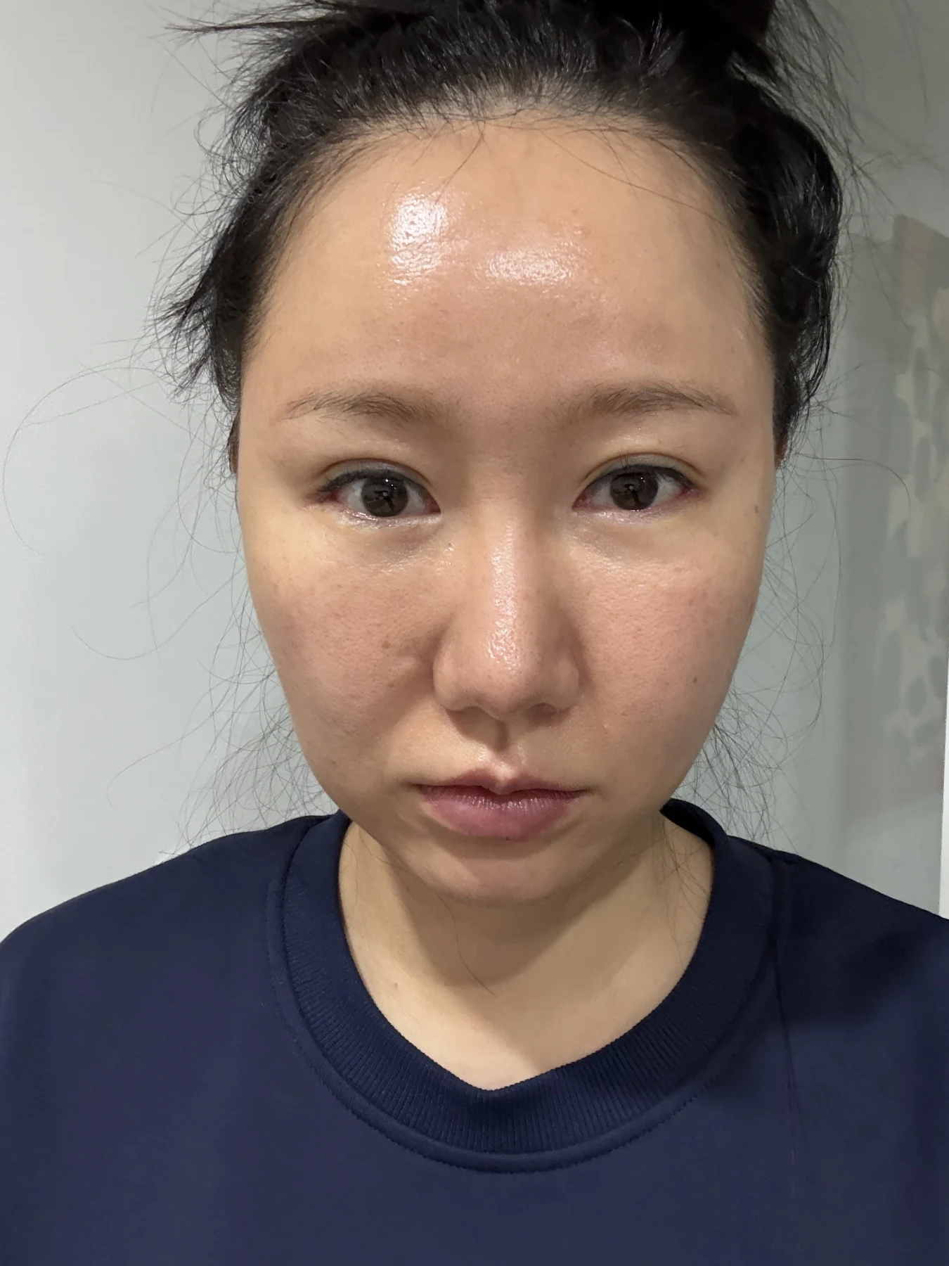 Eye-area comparison from before treatment to one month · Case 079 at Answer Plastic Surgery. Front view — 3 weeks, eye-area comparison from before treatment to one month at Answer Plastic Surgery (case 079).