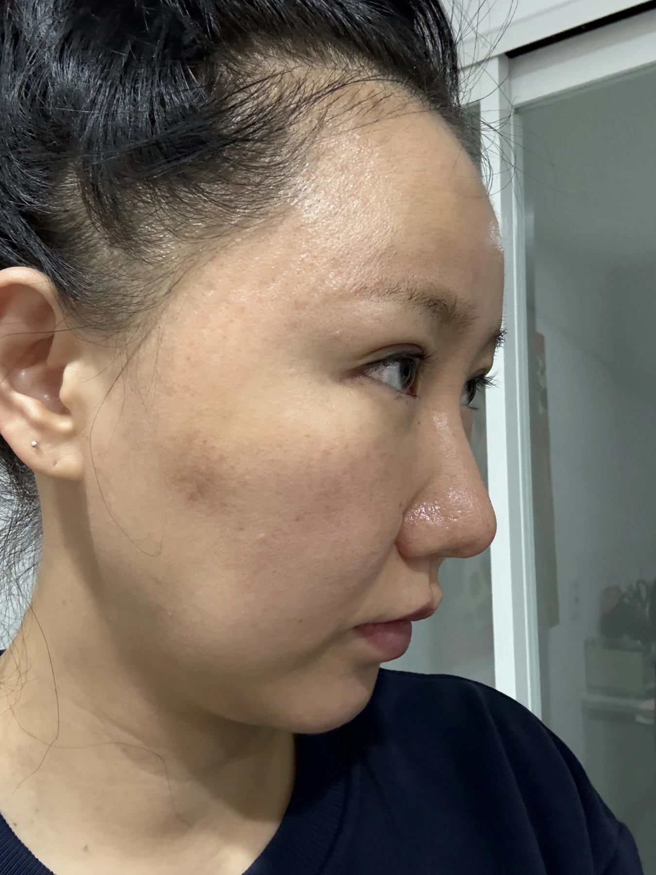 Eye-area comparison from before treatment to one month · Case 079 at Answer Plastic Surgery. Angled view — 3 weeks, eye-area comparison from before treatment to one month at Answer Plastic Surgery (case 079).
