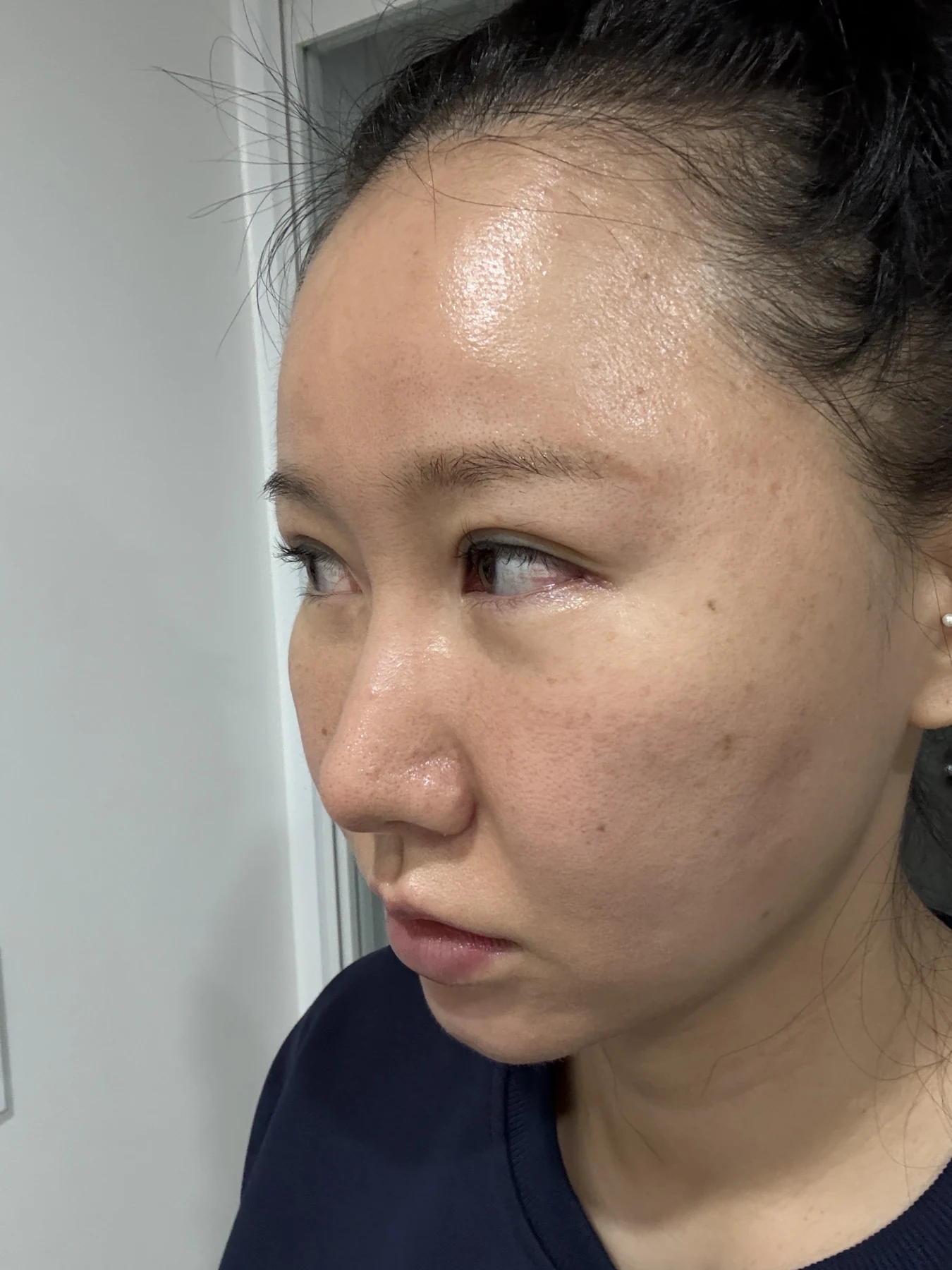 Eye-area comparison from before treatment to one month · Case 079 at Answer Plastic Surgery. Opposite angled view — 3 weeks, eye-area comparison from before treatment to one month at Answer Plastic Surgery (case 079).