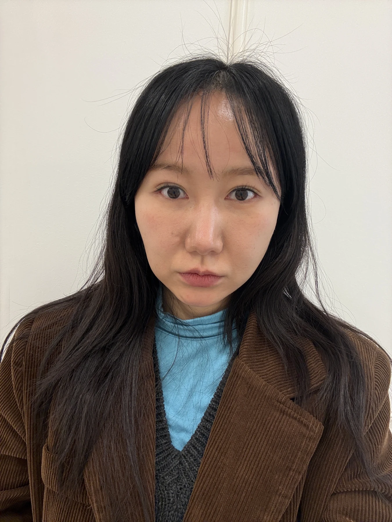 Eye-area comparison from before treatment to one month · Case 079 at Answer Plastic Surgery. Front view — 1 month, eye-area comparison from before treatment to one month at Answer Plastic Surgery (case 079).