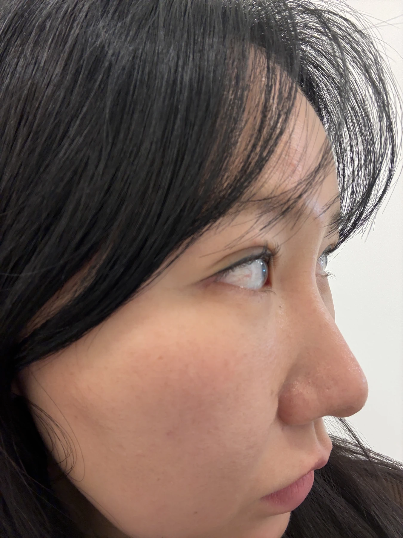 Eye-area comparison from before treatment to one month · Case 079 at Answer Plastic Surgery. Angled view — 1 month, eye-area comparison from before treatment to one month at Answer Plastic Surgery (case 079).