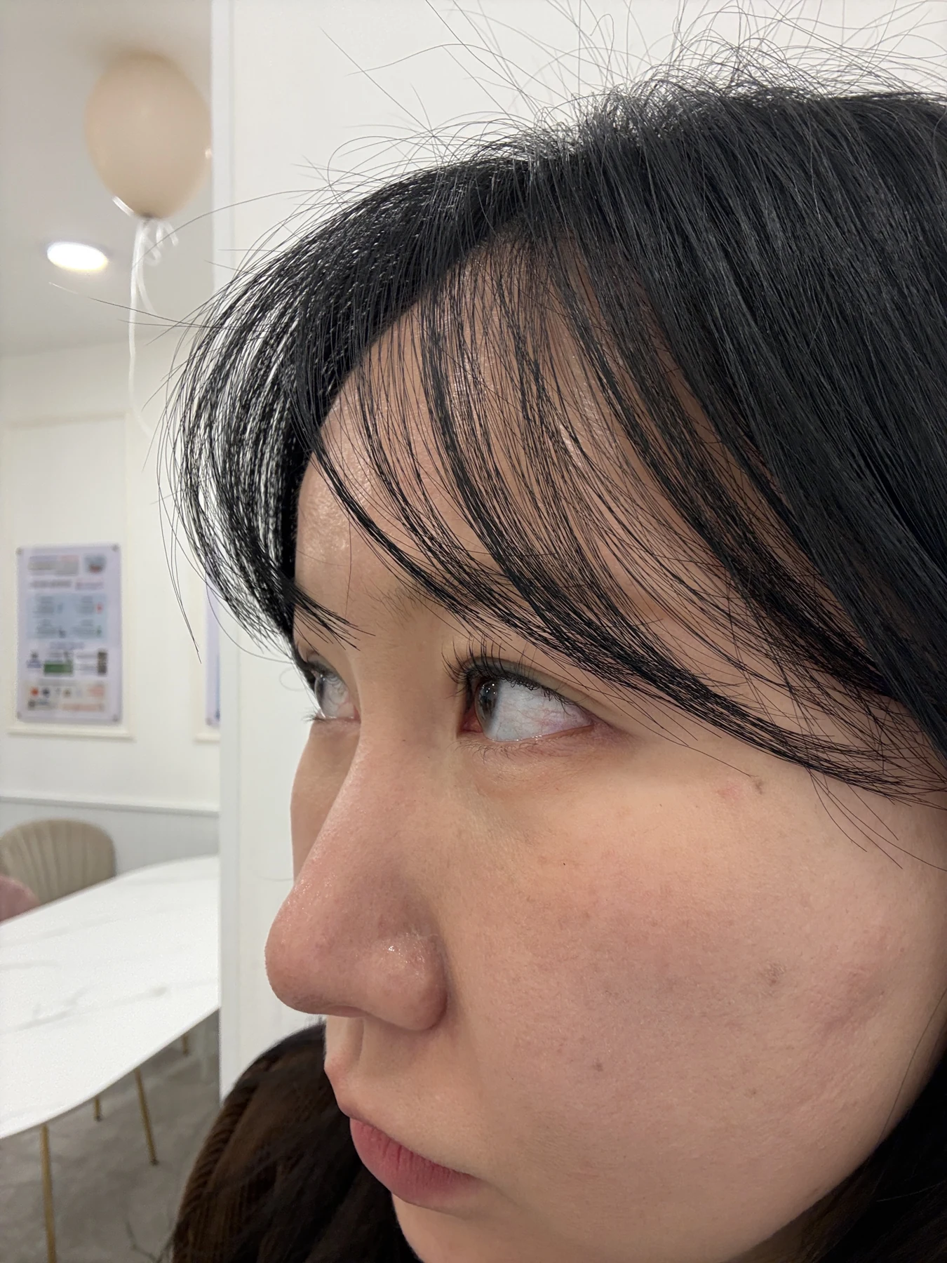 Eye-area comparison from before treatment to one month · Case 079 at Answer Plastic Surgery. Opposite angled view — 1 month, eye-area comparison from before treatment to one month at Answer Plastic Surgery (case 079).