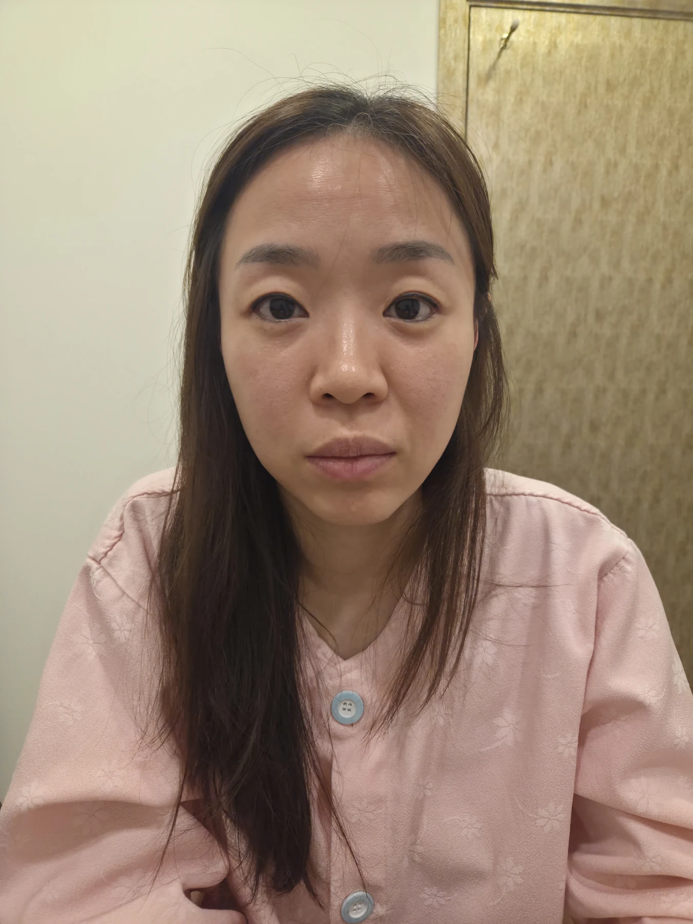 Non-incisional eyelid surgery: recovery through three months · Case 080 at Answer Plastic Surgery. Front view — before, non-incisional eyelid surgery at Answer Plastic Surgery (case 080).