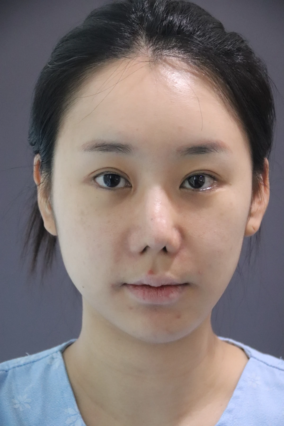 Eye-area surgery: photographs through one month · Case 081 at Answer Plastic Surgery. Front view — before, eye-area surgery at Answer Plastic Surgery (case 081).