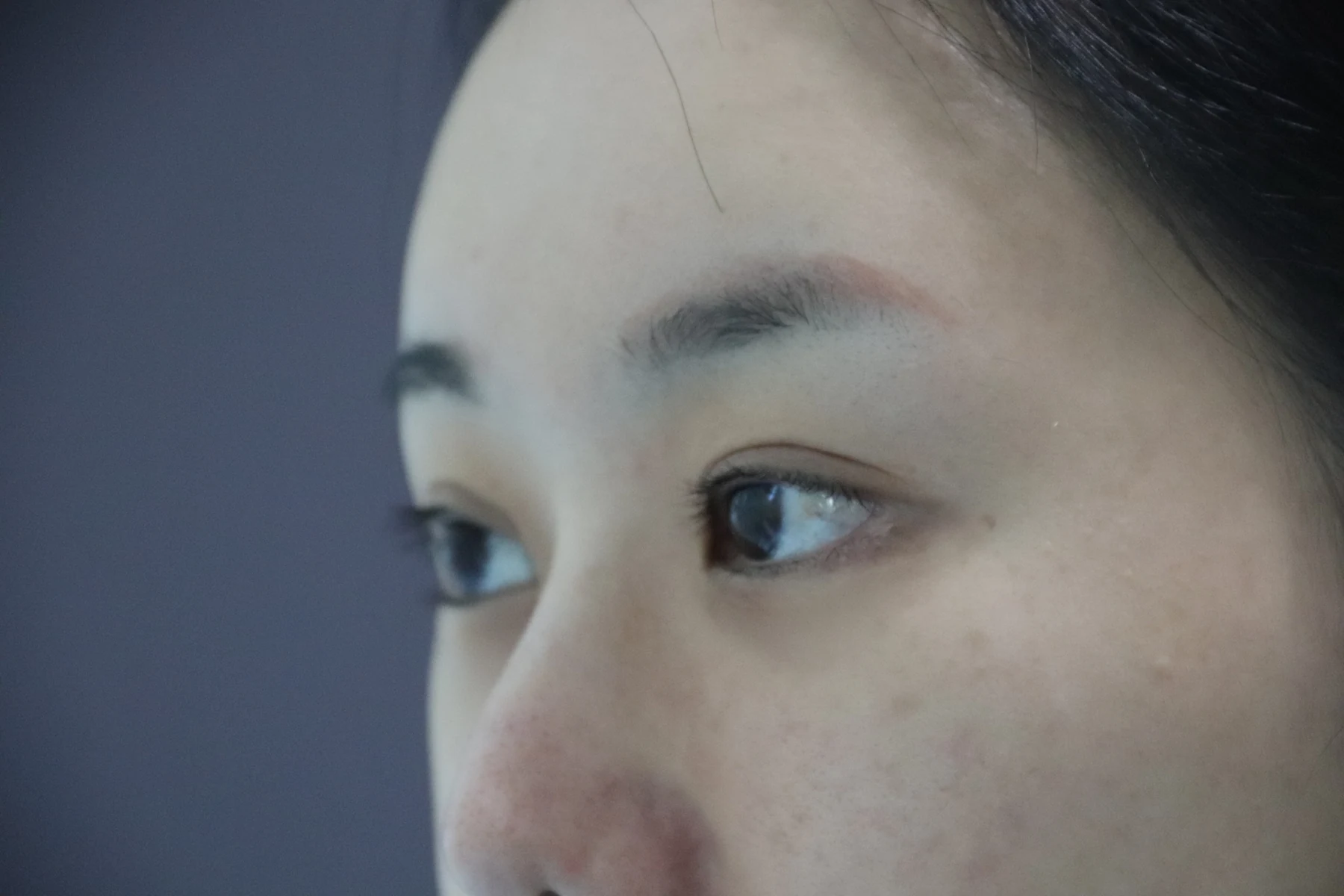 Eye-area surgery: photographs through one month · Case 081 at Answer Plastic Surgery. Oblique view — before, eye-area surgery at Answer Plastic Surgery (case 081).