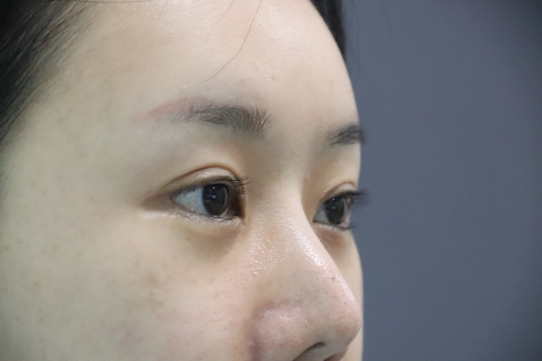 Eye-area surgery: photographs through one month · Case 081 at Answer Plastic Surgery. Opposite oblique view — before, eye-area surgery at Answer Plastic Surgery (case 081).