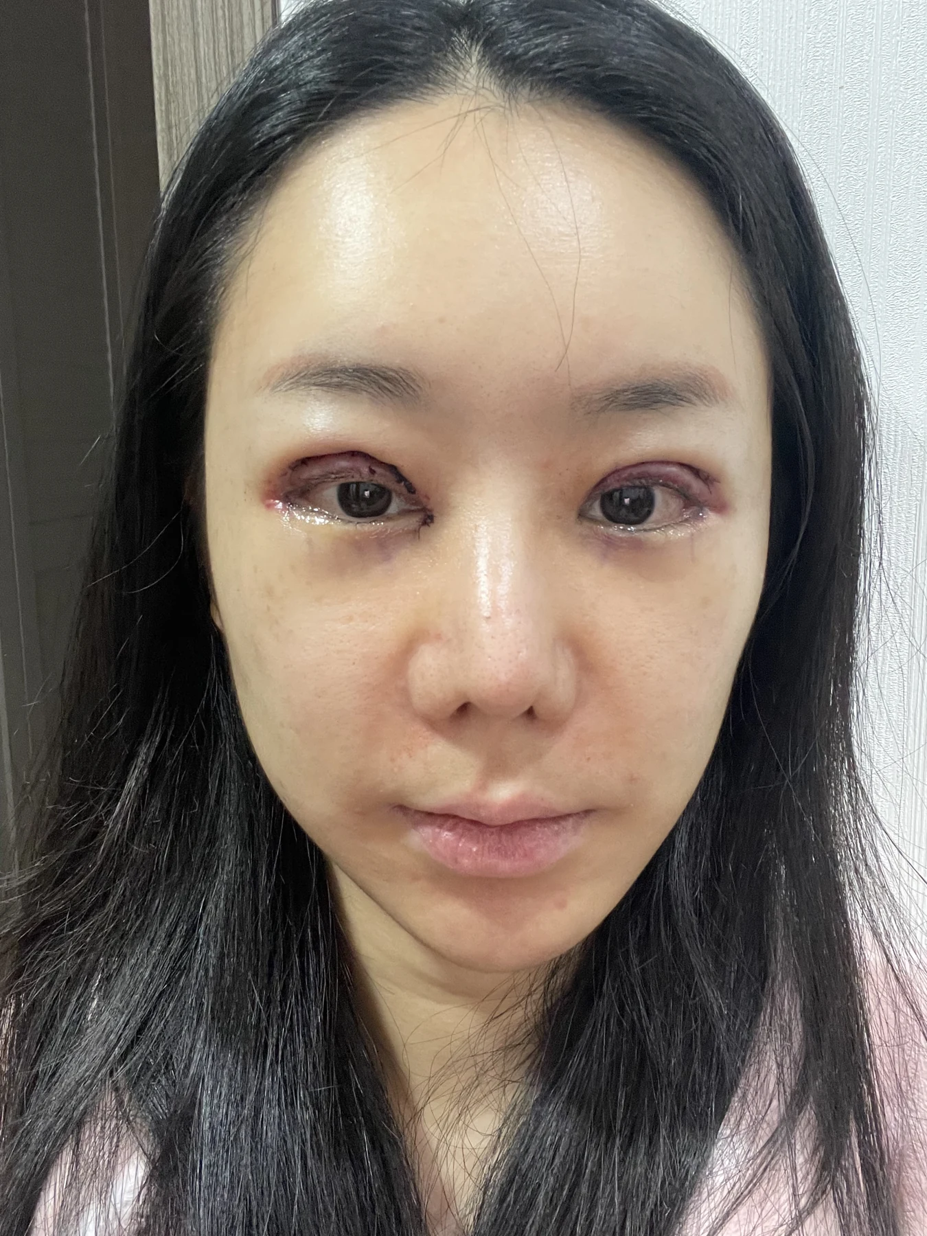 Eye-area surgery: photographs through one month · Case 081 at Answer Plastic Surgery. Front view — surgery day, eye-area surgery at Answer Plastic Surgery (case 081).
