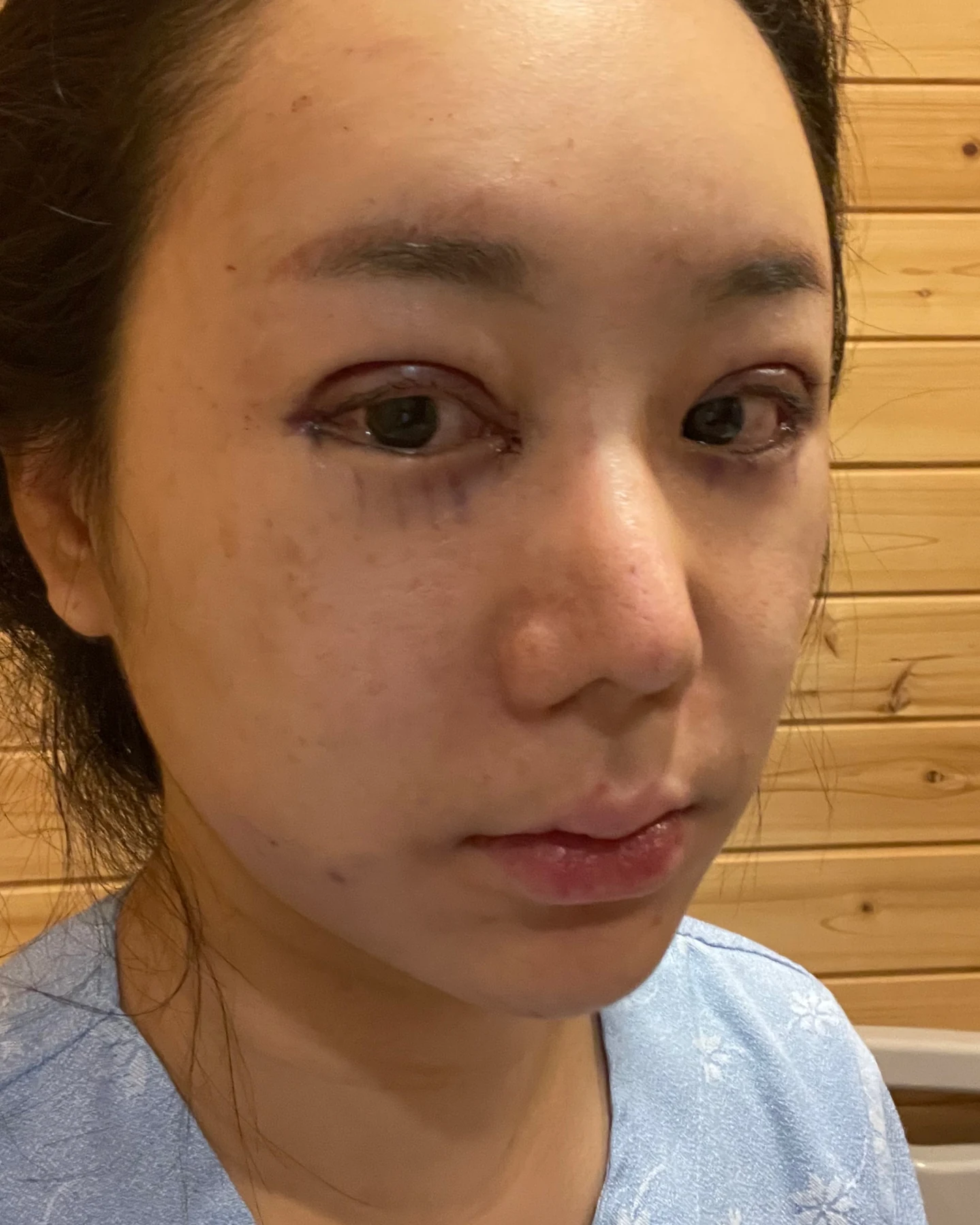 Eye-area surgery: photographs through one month · Case 081 at Answer Plastic Surgery. Oblique view — surgery day, eye-area surgery at Answer Plastic Surgery (case 081).