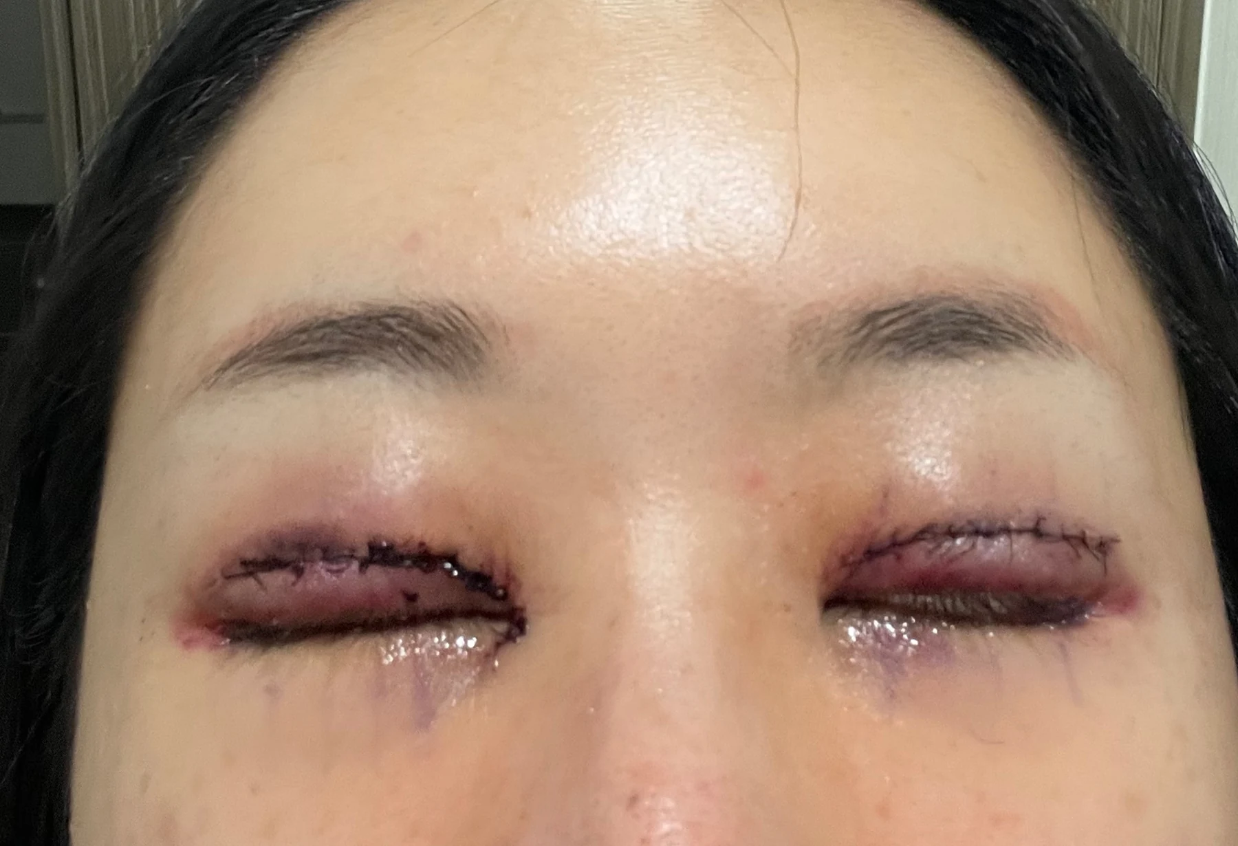 Eye-area surgery: photographs through one month · Case 081 at Answer Plastic Surgery. Closed-eyelid close-up — surgery day, eye-area surgery at Answer Plastic Surgery (case 081).