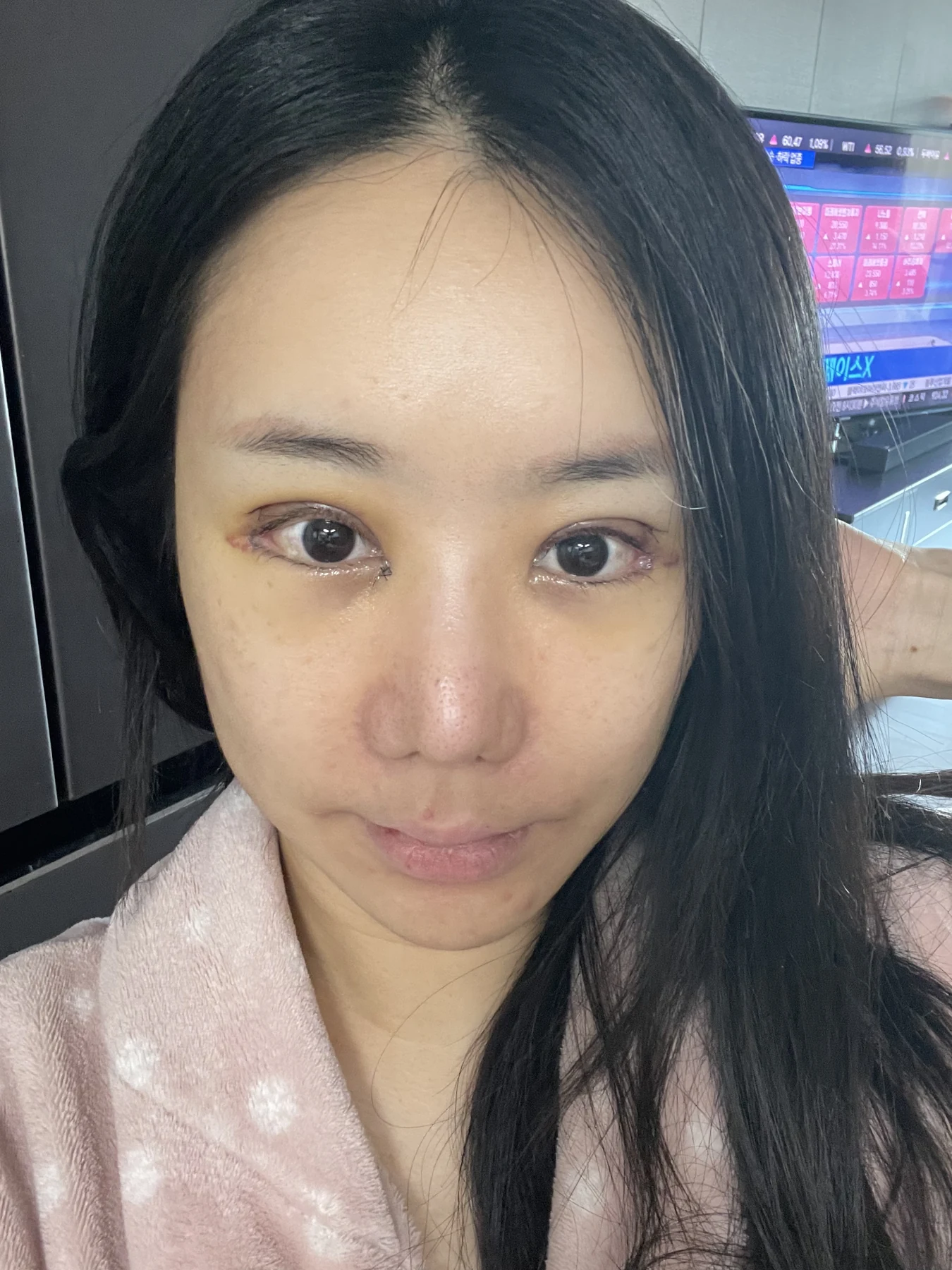 Eye-area surgery: photographs through one month · Case 081 at Answer Plastic Surgery. Front view — 4 days after surgery, eye-area surgery at Answer Plastic Surgery (case 081).