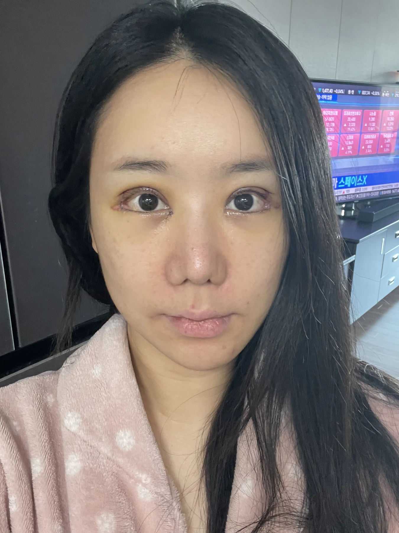 Eye-area surgery: photographs through one month · Case 081 at Answer Plastic Surgery. Alternate front view — 4 days after surgery, eye-area surgery at Answer Plastic Surgery (case 081).