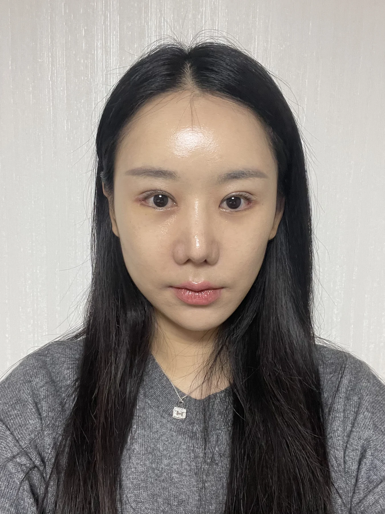 Eye-area surgery: photographs through one month · Case 081 at Answer Plastic Surgery. Front view — 1 week after surgery, eye-area surgery at Answer Plastic Surgery (case 081).