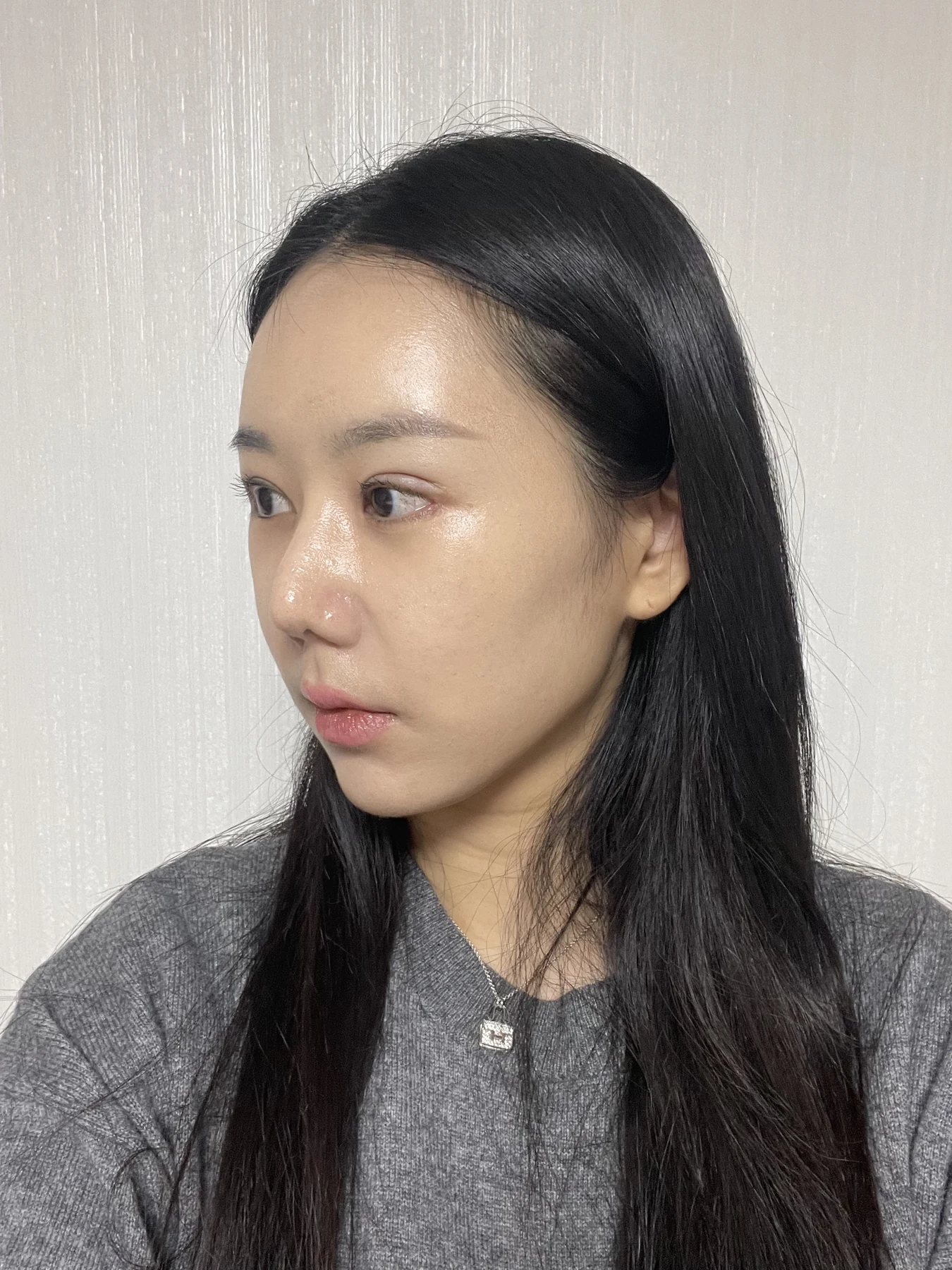 Eye-area surgery: photographs through one month · Case 081 at Answer Plastic Surgery. Oblique view — 1 week after surgery, eye-area surgery at Answer Plastic Surgery (case 081).