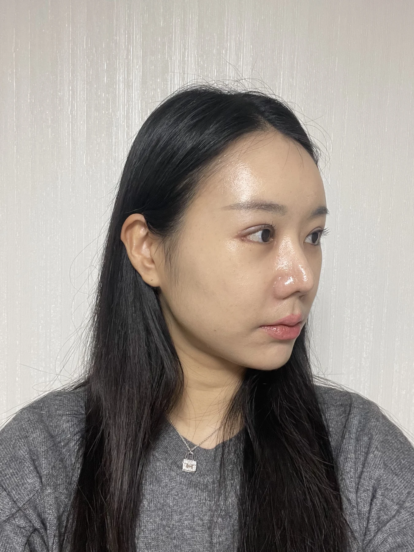 Eye-area surgery: photographs through one month · Case 081 at Answer Plastic Surgery. Opposite oblique view — 1 week after surgery, eye-area surgery at Answer Plastic Surgery (case 081).