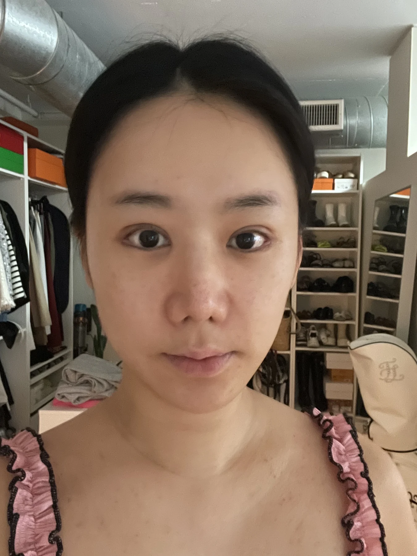 Eye-area surgery: photographs through one month · Case 081 at Answer Plastic Surgery. Front view — 2 weeks after surgery, eye-area surgery at Answer Plastic Surgery (case 081).