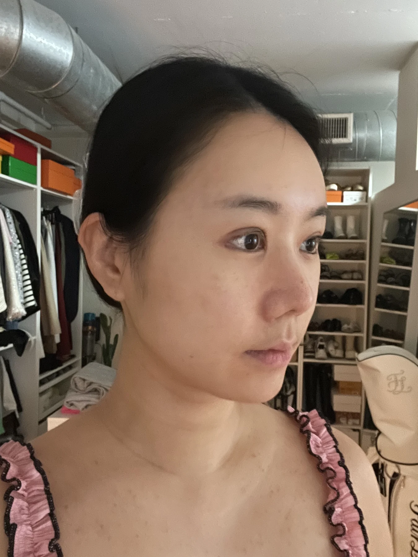 Eye-area surgery: photographs through one month · Case 081 at Answer Plastic Surgery. Oblique view — 2 weeks after surgery, eye-area surgery at Answer Plastic Surgery (case 081).