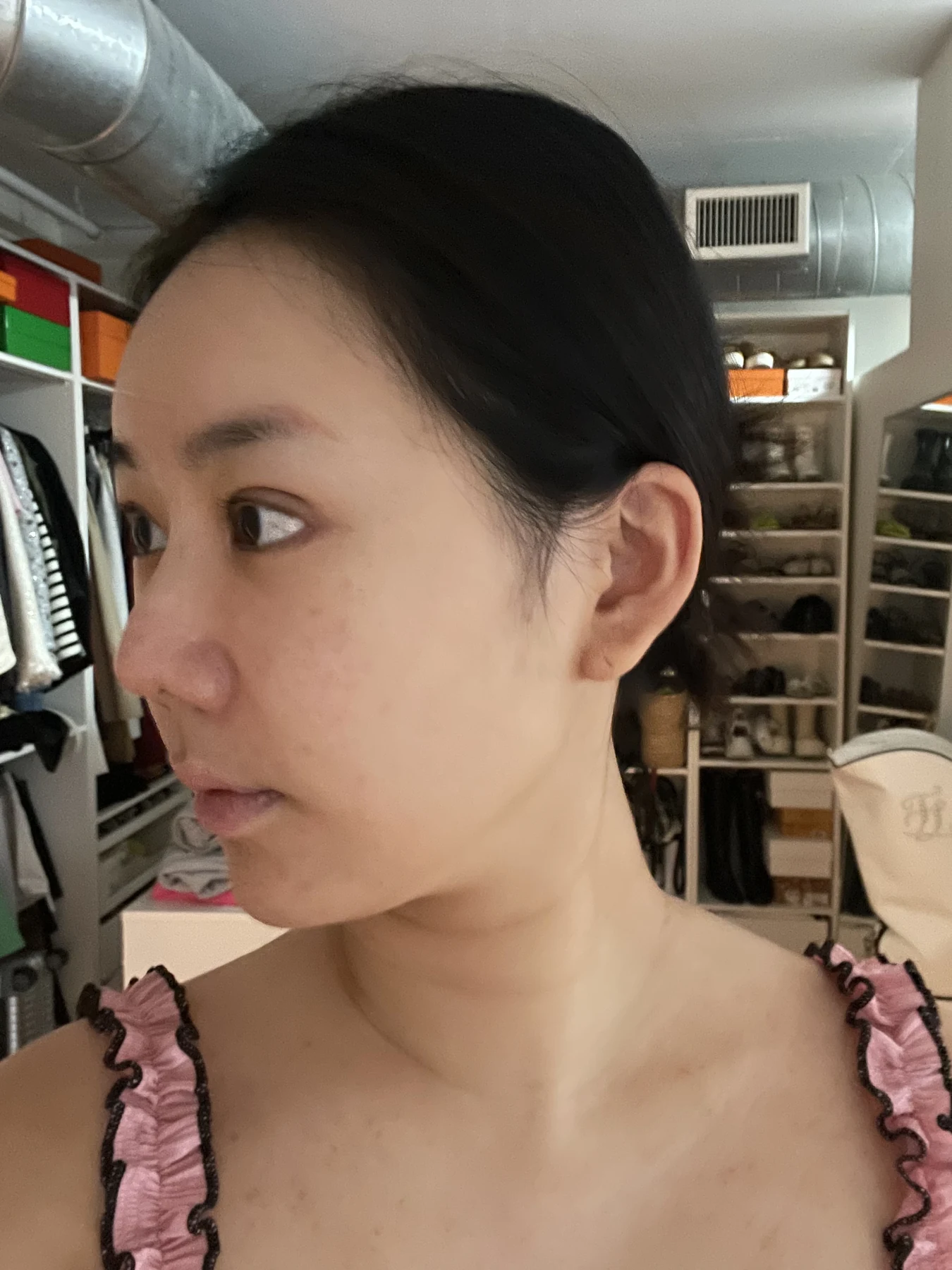 Eye-area surgery: photographs through one month · Case 081 at Answer Plastic Surgery. Opposite oblique view — 2 weeks after surgery, eye-area surgery at Answer Plastic Surgery (case 081).