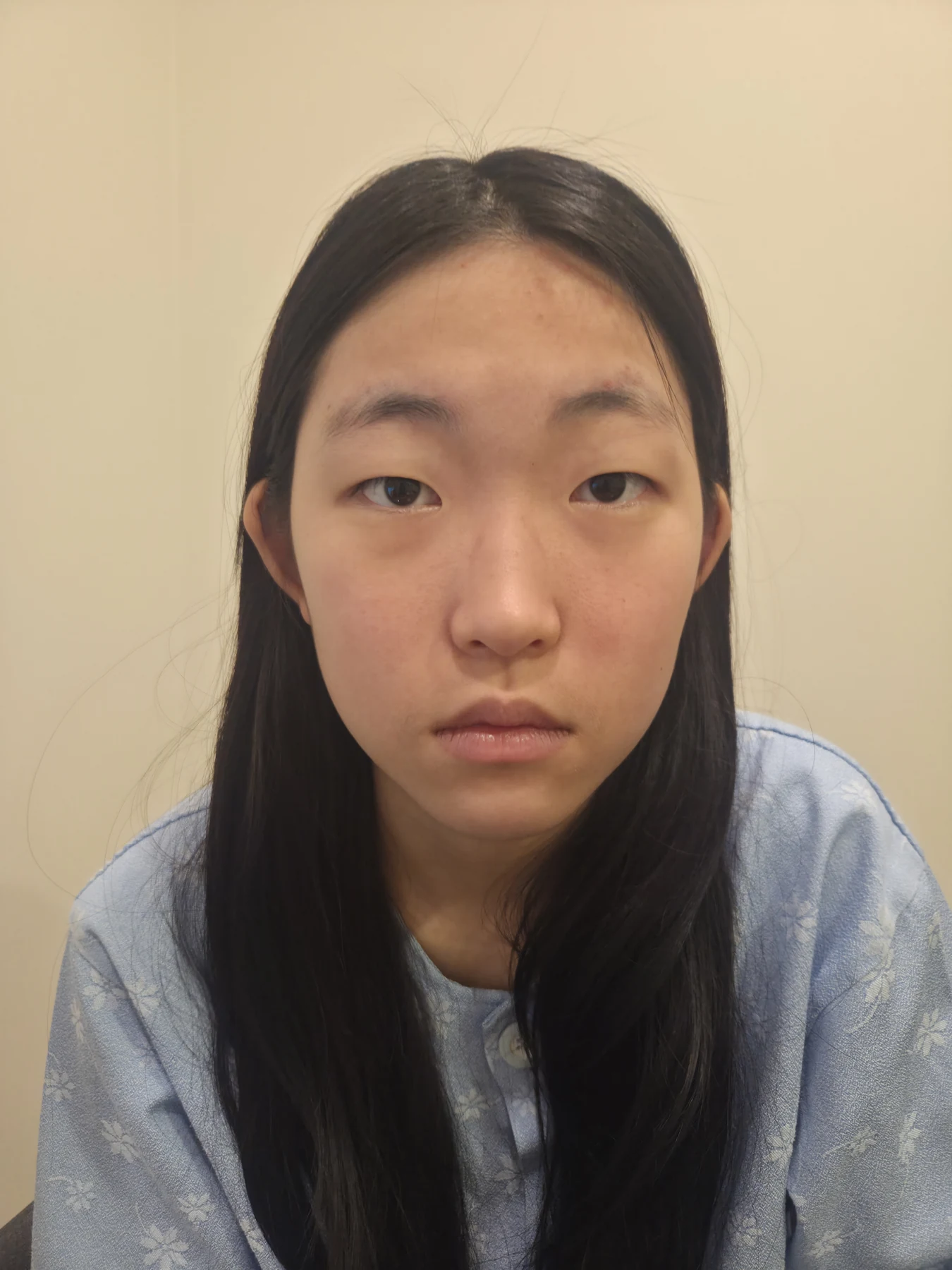 Eyelid surgery: photographs from surgery day to three months · Case 082 at Answer Plastic Surgery. Front view — before, eyelid surgery at Answer Plastic Surgery (case 082).