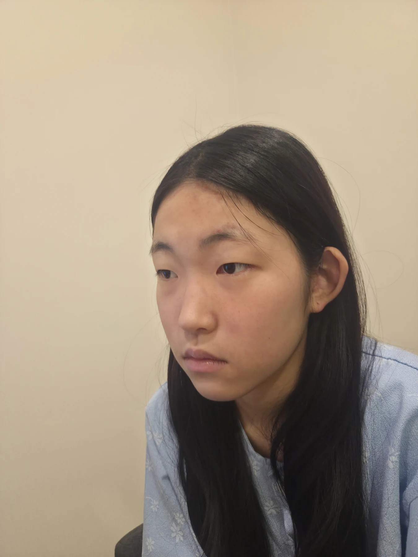 Eyelid surgery: photographs from surgery day to three months · Case 082 at Answer Plastic Surgery. Opposite oblique view — before, eyelid surgery at Answer Plastic Surgery (case 082).
