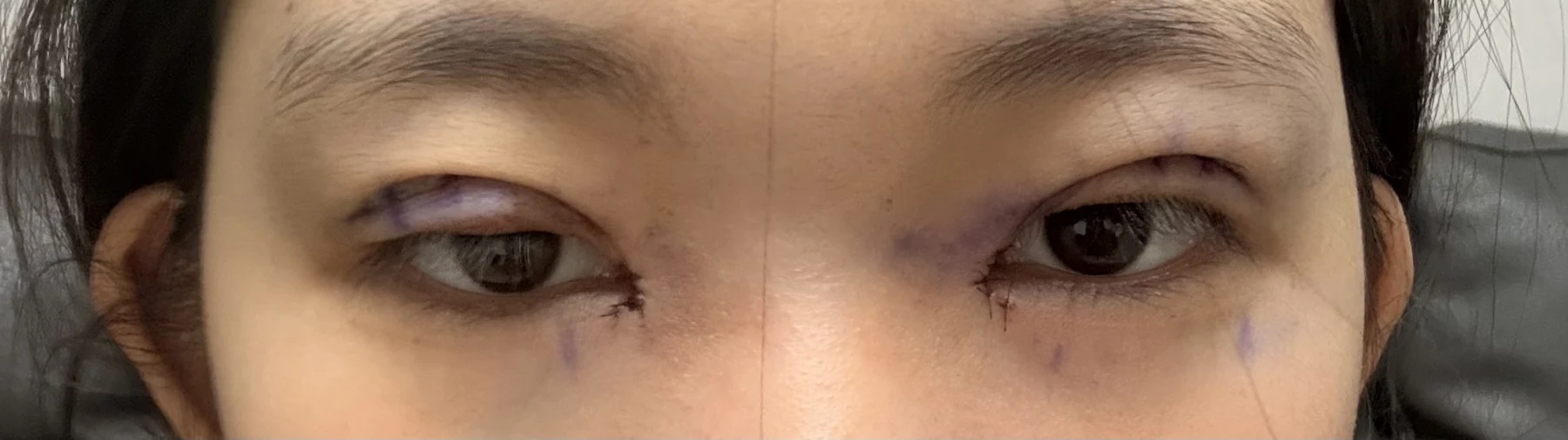Eyelid surgery: photographs from surgery day to three months · Case 082 at Answer Plastic Surgery. Front eye close-up — surgery day, eyelid surgery at Answer Plastic Surgery (case 082).