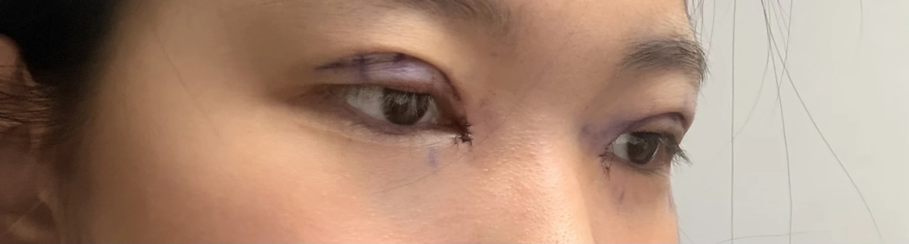 Eyelid surgery: photographs from surgery day to three months · Case 082 at Answer Plastic Surgery. Oblique eye close-up — surgery day, eyelid surgery at Answer Plastic Surgery (case 082).
