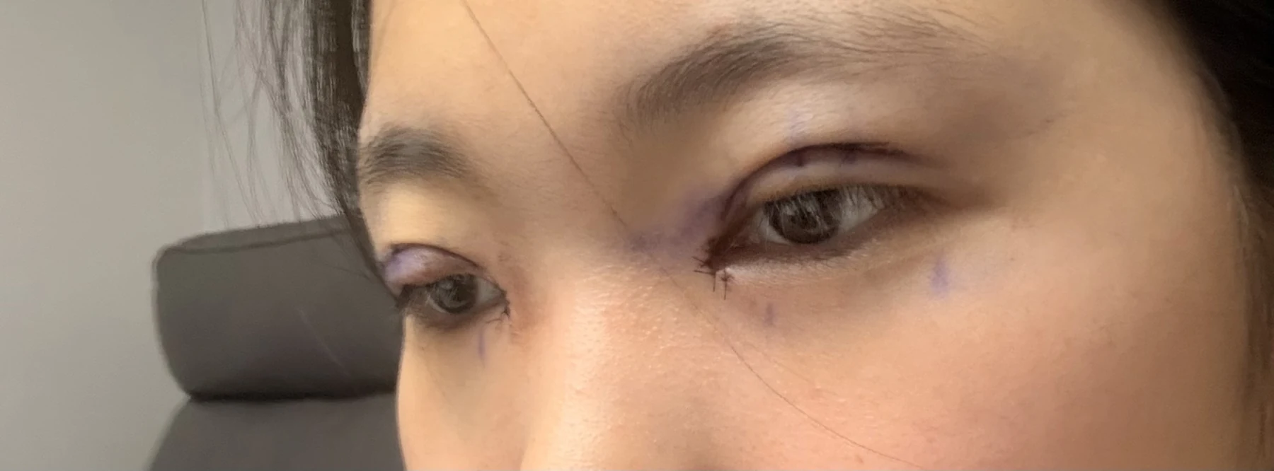 Eyelid surgery: photographs from surgery day to three months · Case 082 at Answer Plastic Surgery. Opposite oblique eye close-up — surgery day, eyelid surgery at Answer Plastic Surgery (case 082).