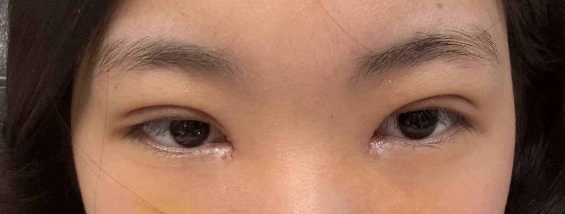 Eyelid surgery: photographs from surgery day to three months · Case 082 at Answer Plastic Surgery. Front eye close-up — 1 week after surgery, eyelid surgery at Answer Plastic Surgery (case 082).