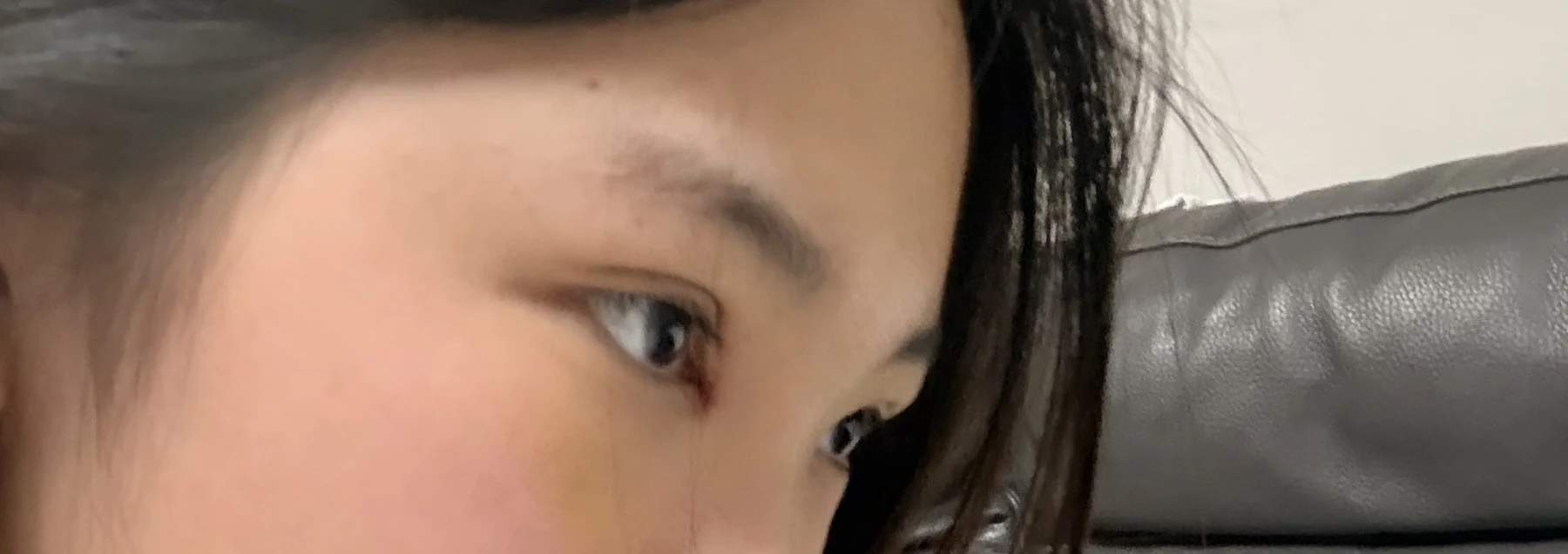 Eyelid surgery: photographs from surgery day to three months · Case 082 at Answer Plastic Surgery. Oblique eye close-up — 1 week after surgery, eyelid surgery at Answer Plastic Surgery (case 082).