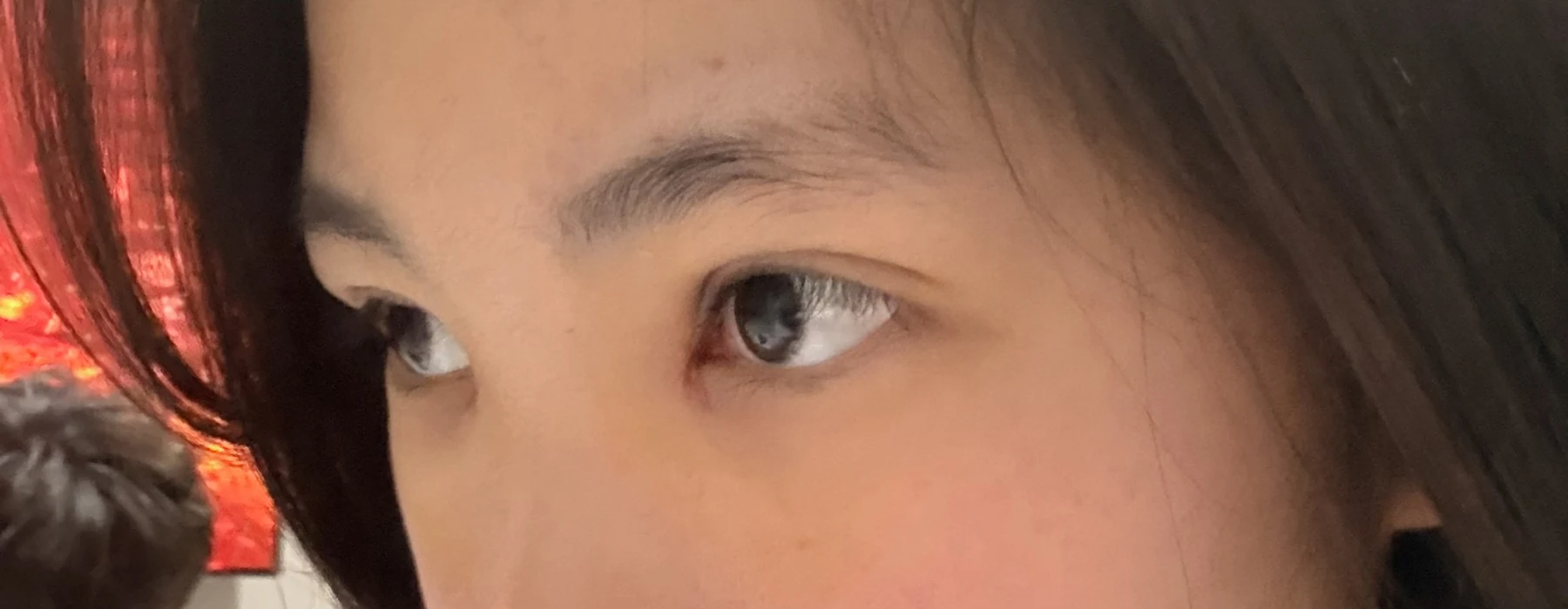 Eyelid surgery: photographs from surgery day to three months · Case 082 at Answer Plastic Surgery. Opposite oblique eye close-up — 1 week after surgery, eyelid surgery at Answer Plastic Surgery (case 082).