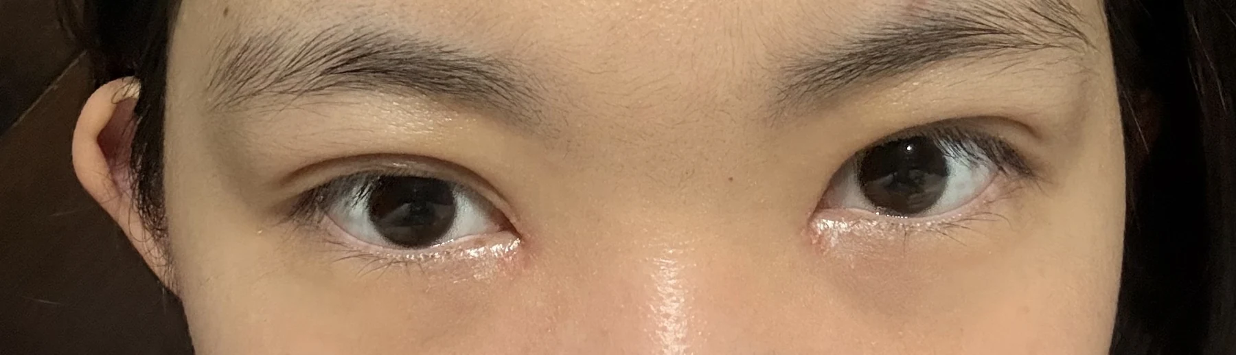 Eyelid surgery: photographs from surgery day to three months · Case 082 at Answer Plastic Surgery. Front eye close-up — 2 weeks after surgery, eyelid surgery at Answer Plastic Surgery (case 082).