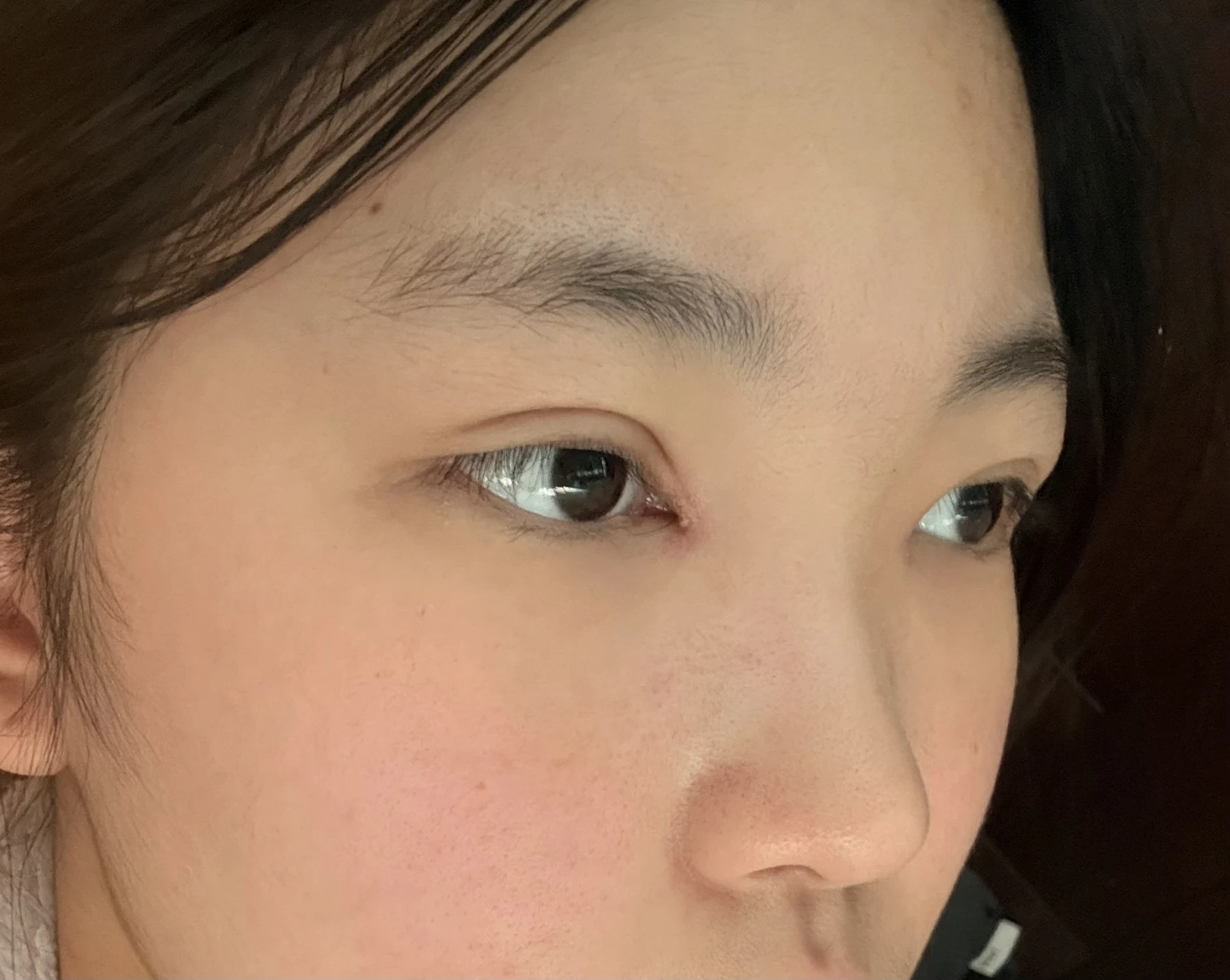 Eyelid surgery: photographs from surgery day to three months · Case 082 at Answer Plastic Surgery. Oblique eye close-up — 2 weeks after surgery, eyelid surgery at Answer Plastic Surgery (case 082).