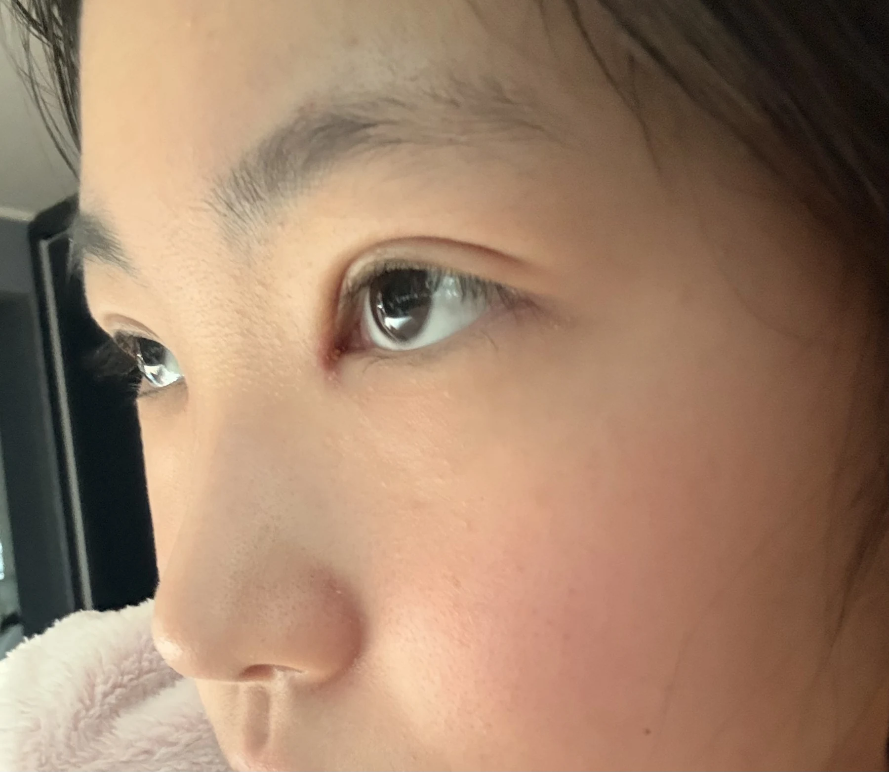 Eyelid surgery: photographs from surgery day to three months · Case 082 at Answer Plastic Surgery. Opposite oblique eye close-up — 2 weeks after surgery, eyelid surgery at Answer Plastic Surgery (case 082).