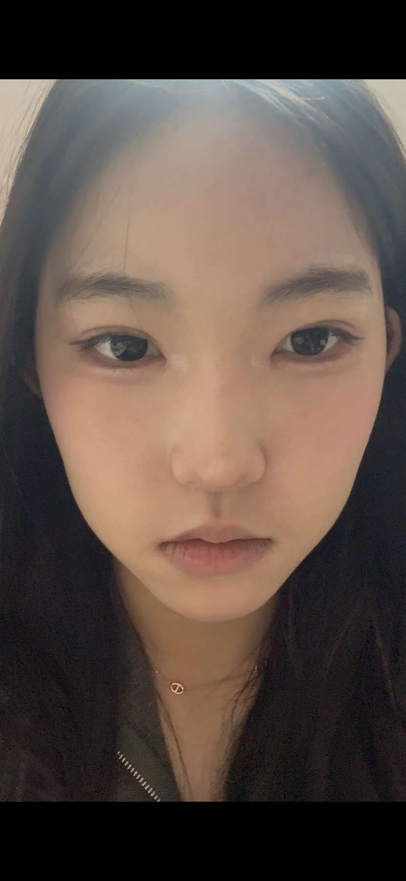 Eyelid surgery: photographs from surgery day to three months · Case 082 at Answer Plastic Surgery. Front view — 3 weeks after surgery, eyelid surgery at Answer Plastic Surgery (case 082).