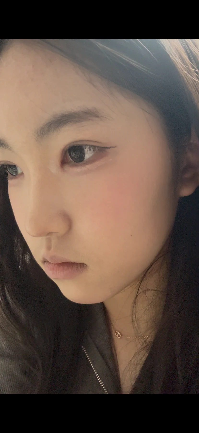 Eyelid surgery: photographs from surgery day to three months · Case 082 at Answer Plastic Surgery. Opposite oblique view — 3 weeks after surgery, eyelid surgery at Answer Plastic Surgery (case 082).