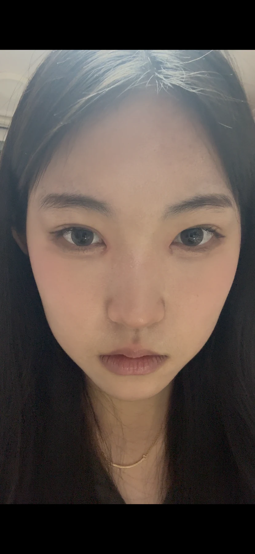 Eyelid surgery: photographs from surgery day to three months · Case 082 at Answer Plastic Surgery. Front view — 1 month after surgery, eyelid surgery at Answer Plastic Surgery (case 082).