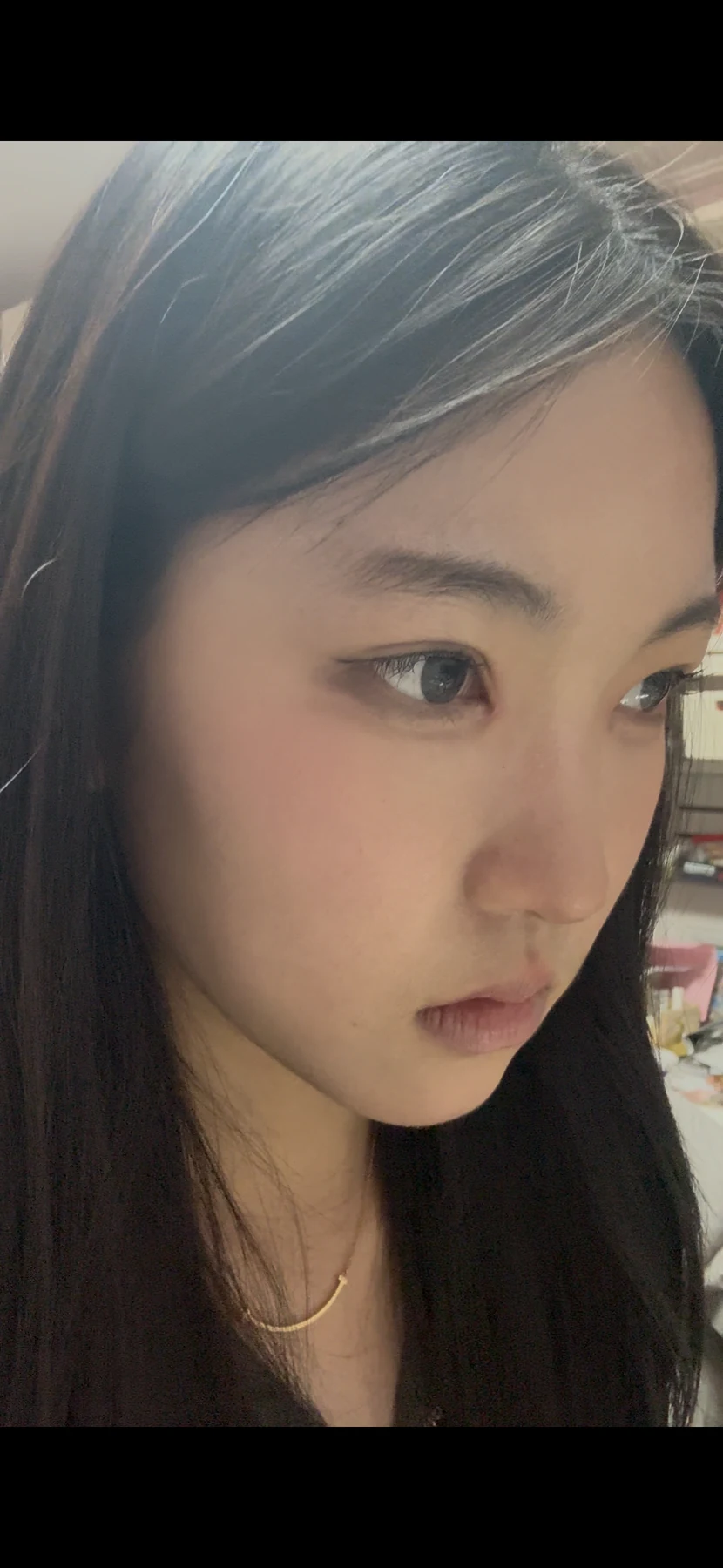 Eyelid surgery: photographs from surgery day to three months · Case 082 at Answer Plastic Surgery. Oblique view — 1 month after surgery, eyelid surgery at Answer Plastic Surgery (case 082).