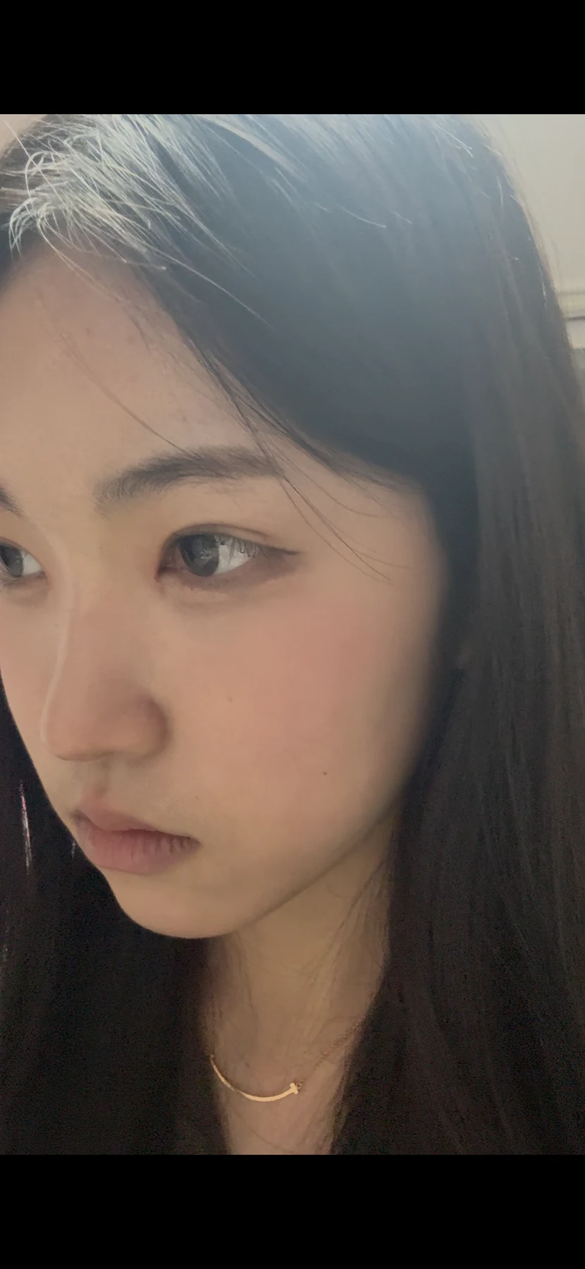 Eyelid surgery: photographs from surgery day to three months · Case 082 at Answer Plastic Surgery. Opposite oblique view — 1 month after surgery, eyelid surgery at Answer Plastic Surgery (case 082).