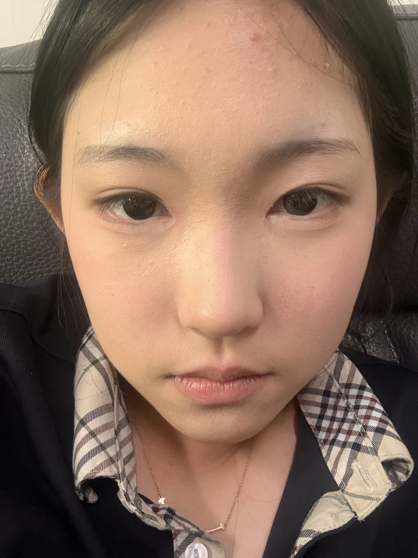 Eyelid surgery: photographs from surgery day to three months · Case 082 at Answer Plastic Surgery. Front view — 2 months after surgery, eyelid surgery at Answer Plastic Surgery (case 082).