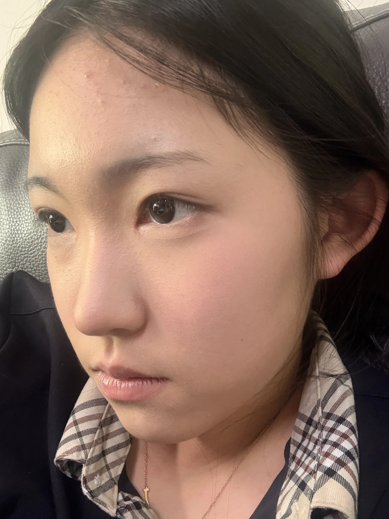 Eyelid surgery: photographs from surgery day to three months · Case 082 at Answer Plastic Surgery. Oblique view — 2 months after surgery, eyelid surgery at Answer Plastic Surgery (case 082).