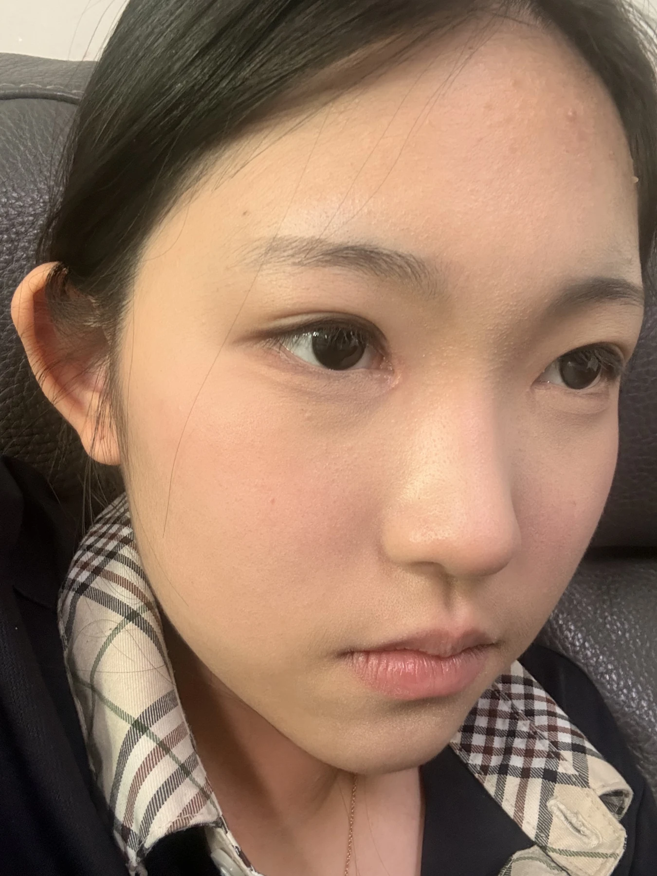 Eyelid surgery: photographs from surgery day to three months · Case 082 at Answer Plastic Surgery. Opposite oblique view — 2 months after surgery, eyelid surgery at Answer Plastic Surgery (case 082).