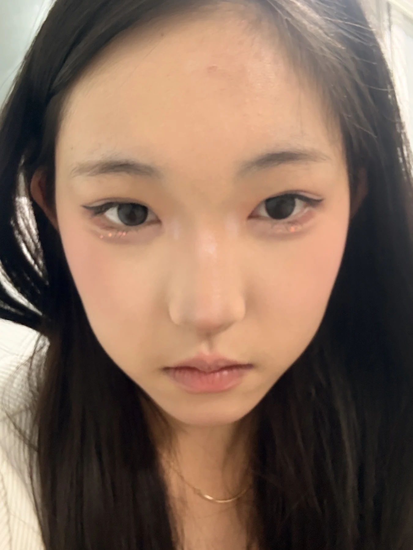 Eyelid surgery: photographs from surgery day to three months · Case 082 at Answer Plastic Surgery. Front view — 3 months after surgery, eyelid surgery at Answer Plastic Surgery (case 082).