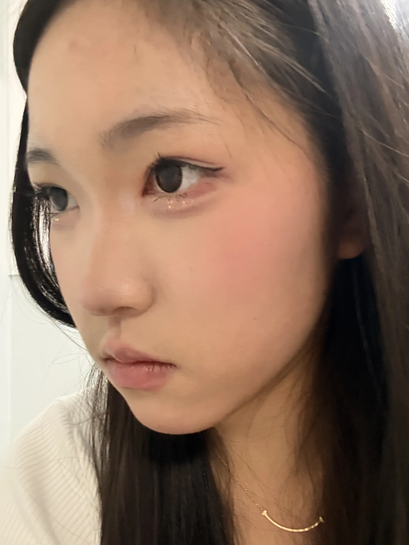 Eyelid surgery: photographs from surgery day to three months · Case 082 at Answer Plastic Surgery. Opposite oblique view — 3 months after surgery, eyelid surgery at Answer Plastic Surgery (case 082).