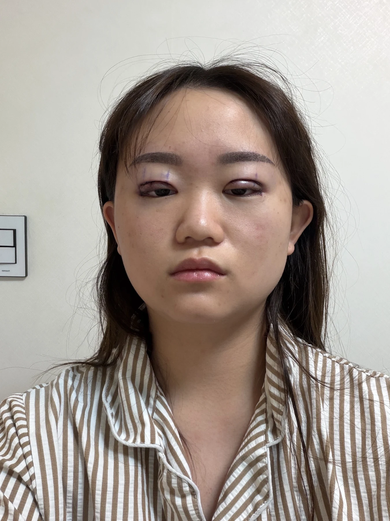 Eye-area surgery: three-month photo timeline · Case 083 at Answer Plastic Surgery. Front view — surgery day, eye-area surgery at Answer Plastic Surgery (case 083).