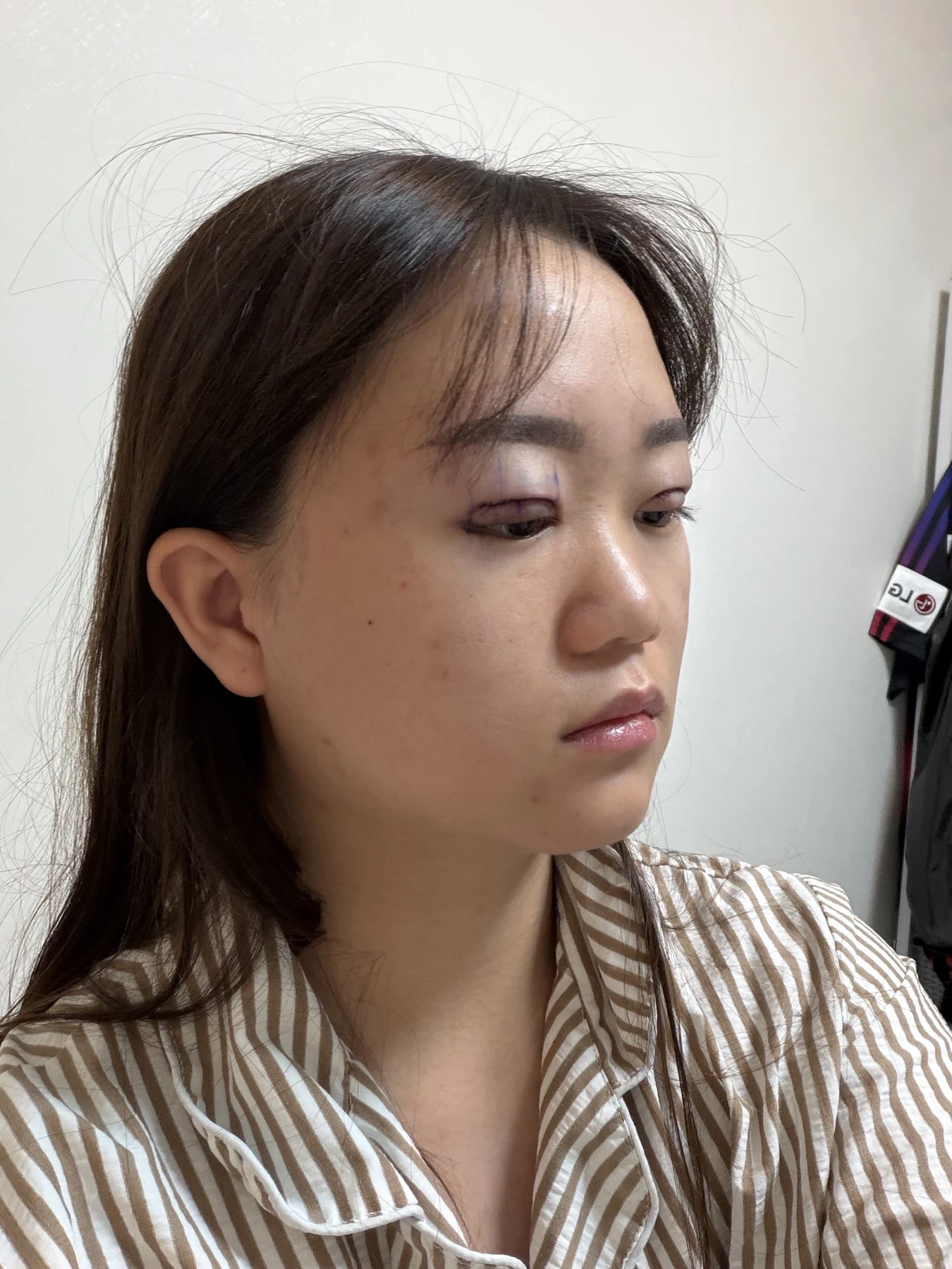 Eye-area surgery: three-month photo timeline · Case 083 at Answer Plastic Surgery. Oblique view — surgery day, eye-area surgery at Answer Plastic Surgery (case 083).